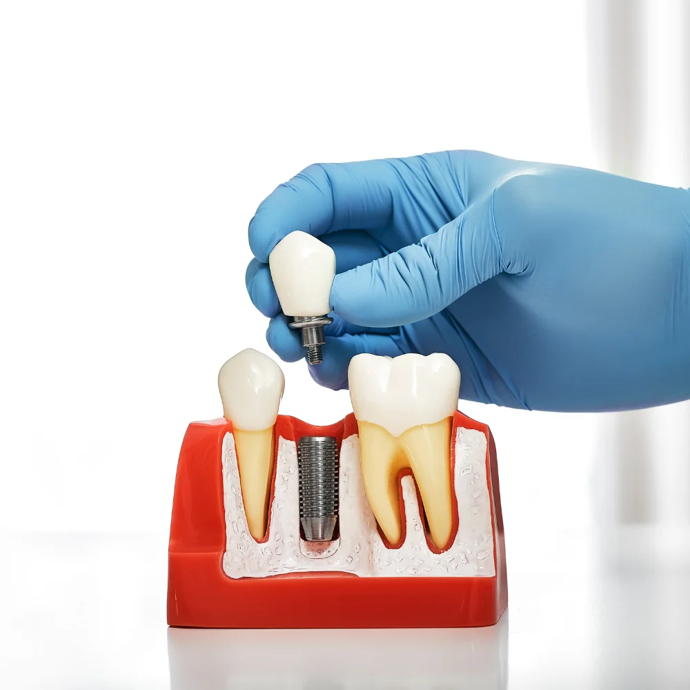 Implantatgetragener Zahnersatz – die Premiumlösung