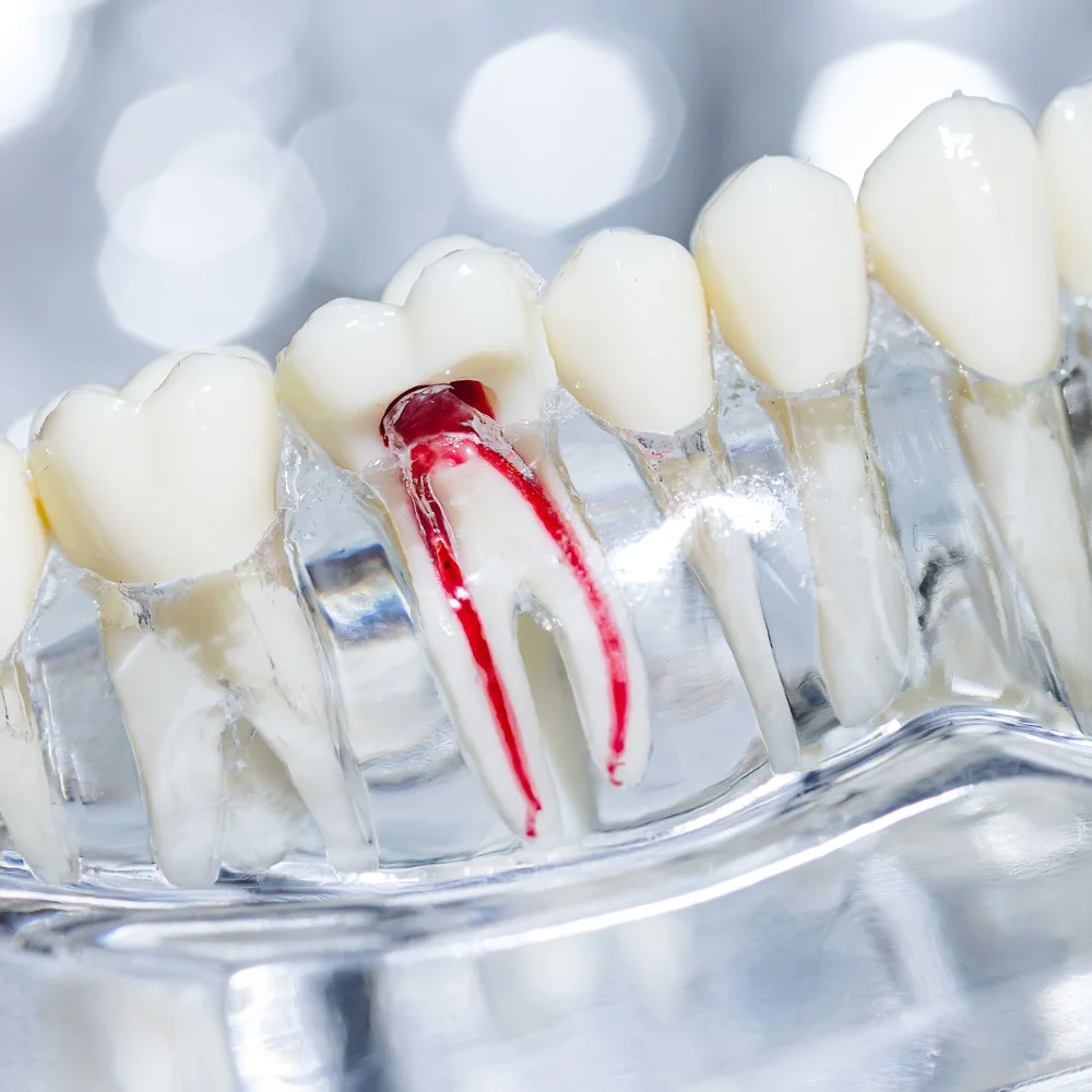 Wurzelkanalbehandlung (Endodontie) in Premen, zahnarzt